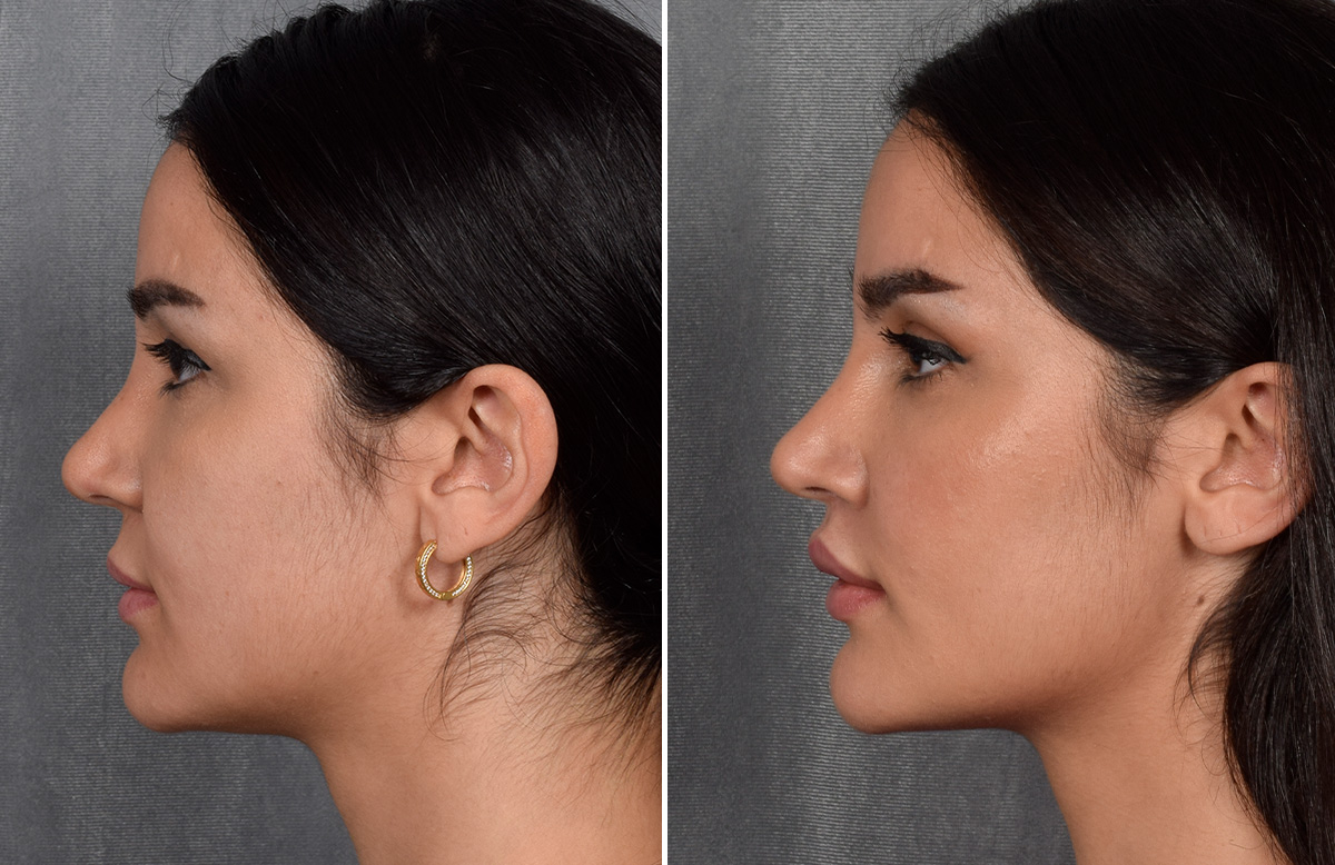 Lip Lift Before & After Gallery - Patient 379894 - Image 12