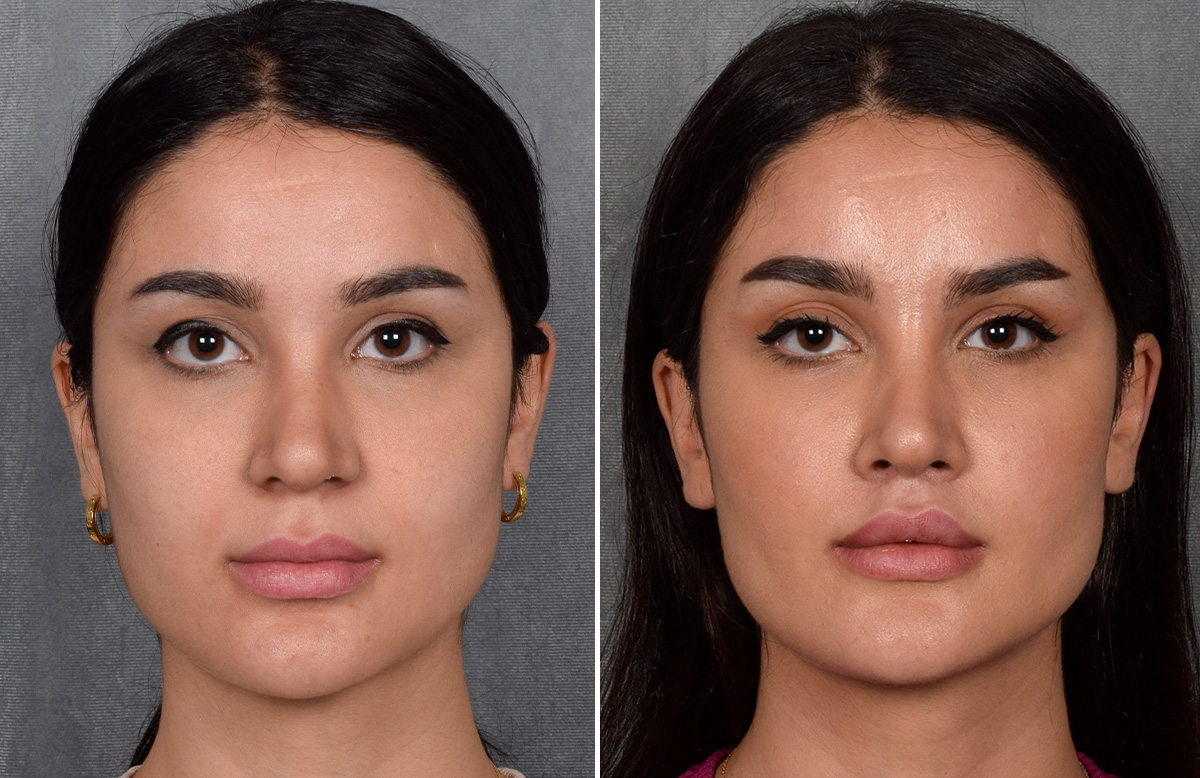 Lip Lift Before & After Gallery - Patient 379894 - Image 7