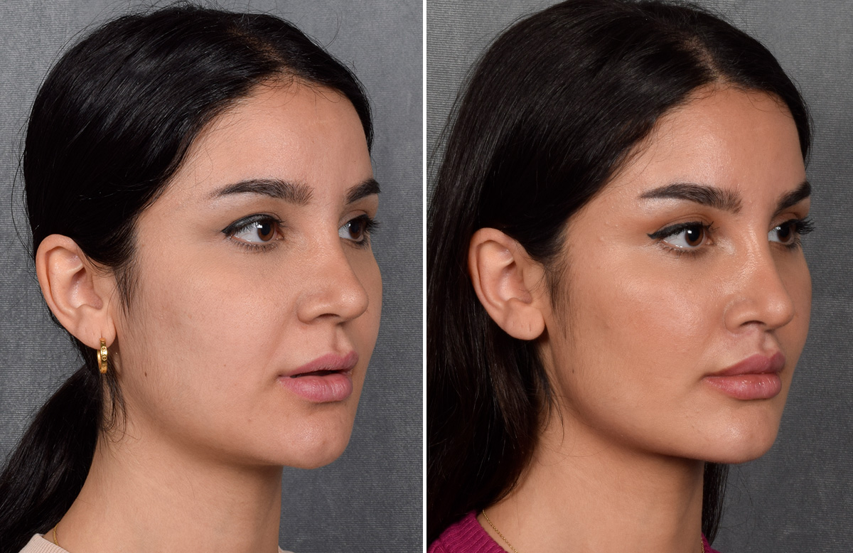 Lip Lift Before & After Gallery - Patient 379894 - Image 9