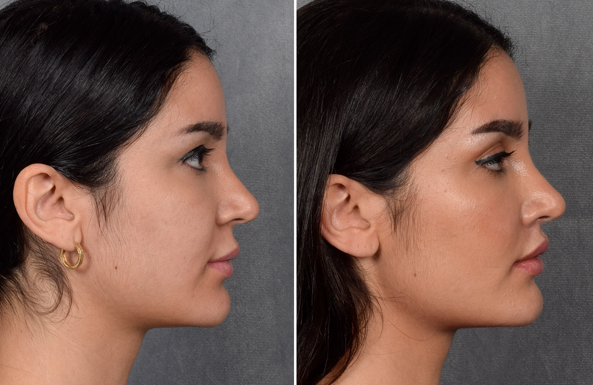 Lip Lift Before & After Gallery - Patient 379894 - Image 10