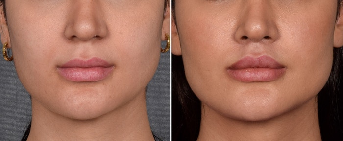 Lip Lift Before & After Gallery - Patient 379894 - Image 1
