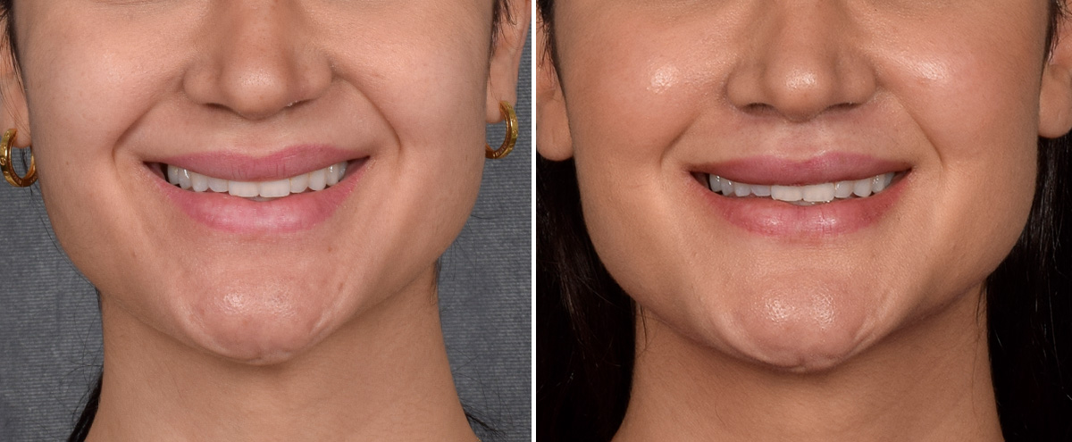 Lip Lift Before & After Gallery - Patient 379894 - Image 2