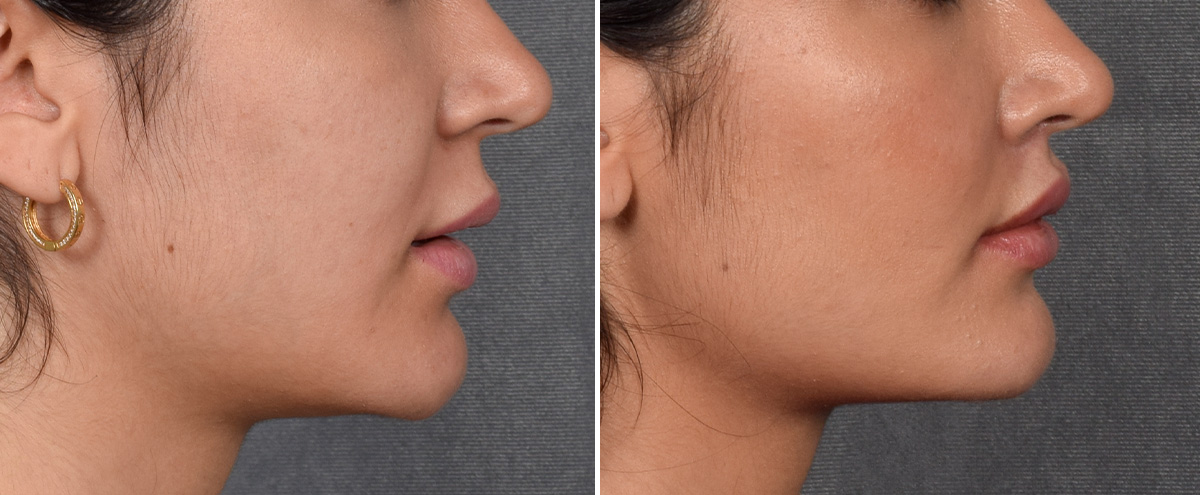 Lip Lift Before & After Gallery - Patient 379894 - Image 4