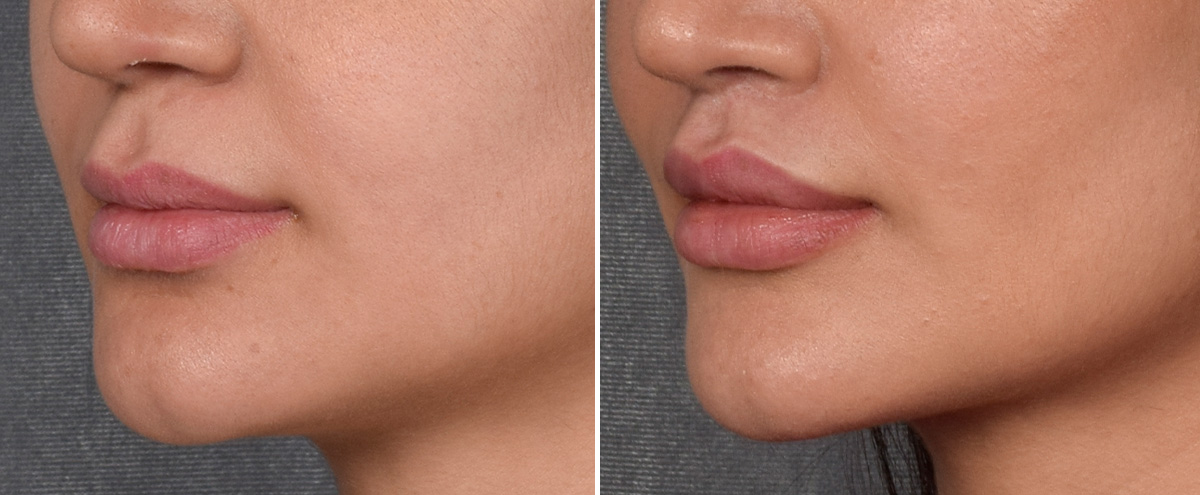 Lip Lift Before & After Gallery - Patient 379894 - Image 5