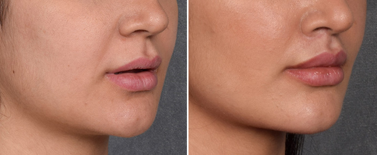 Lip Lift Before & After Gallery - Patient 379894 - Image 3