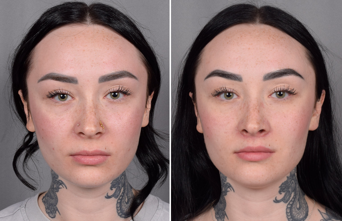 Lip Lift Before & After Gallery - Patient 342755 - Image 8
