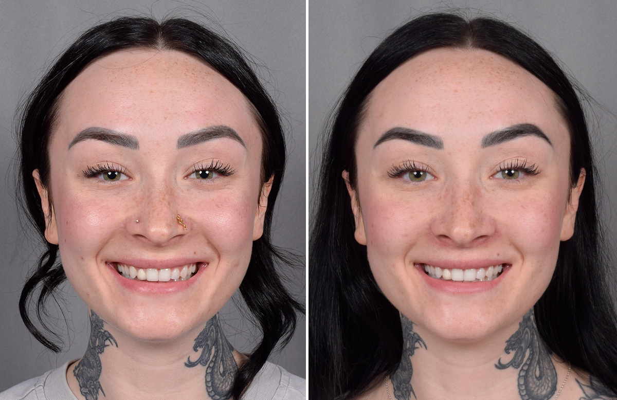 Lip Lift Before & After Gallery - Patient 342755 - Image 9