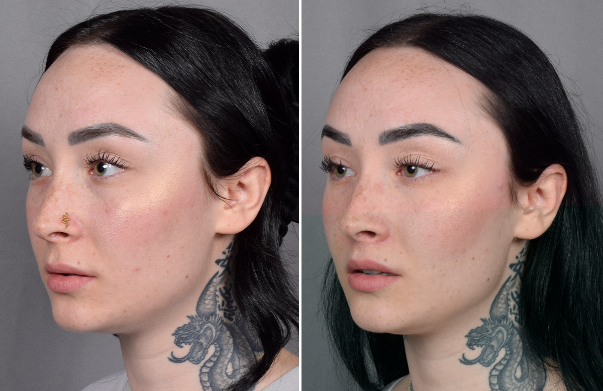 Lip Lift Before & After Gallery - Patient 342755 - Image 12