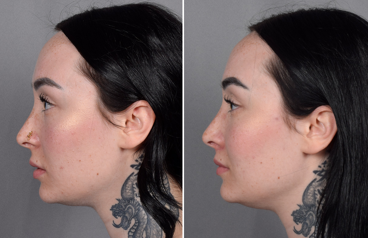 Lip Lift Before & After Gallery - Patient 342755 - Image 13