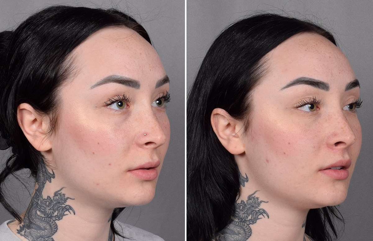 Lip Lift Before & After Gallery - Patient 342755 - Image 10