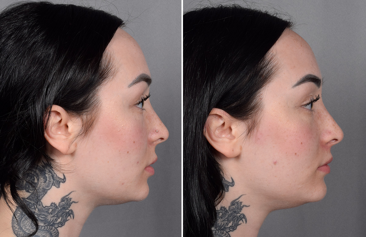 Lip Lift Before & After Gallery - Patient 342755 - Image 11