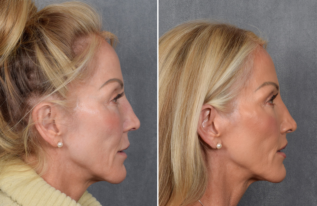 Lip Lift Before & After Gallery - Patient 242147 - Image 10