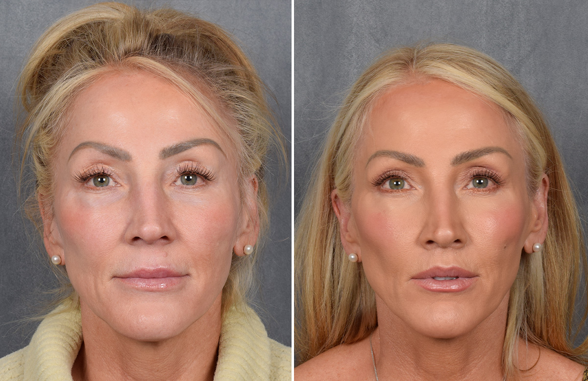 Lip Lift Before & After Gallery - Patient 242147 - Image 7