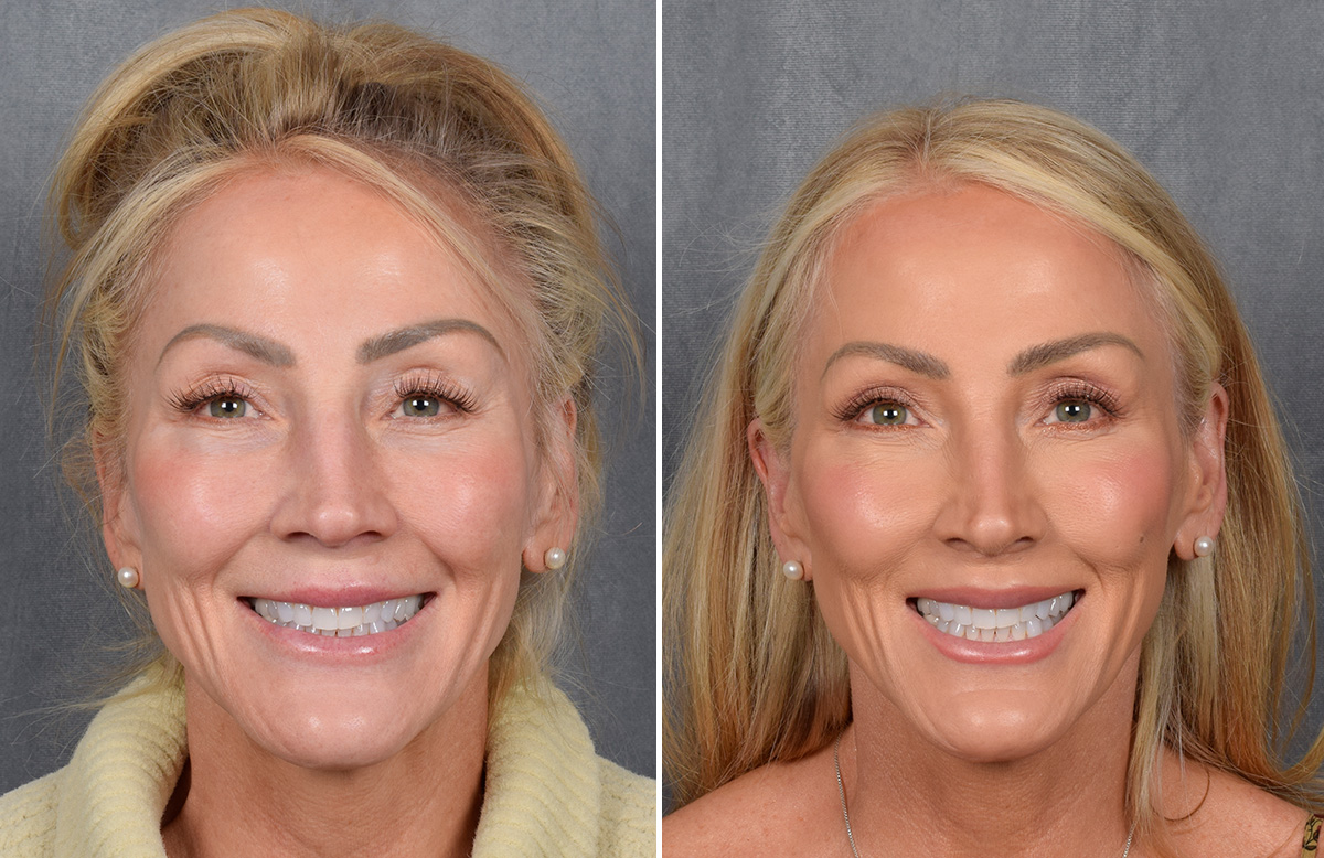 Lip Lift Before & After Gallery - Patient 242147 - Image 8