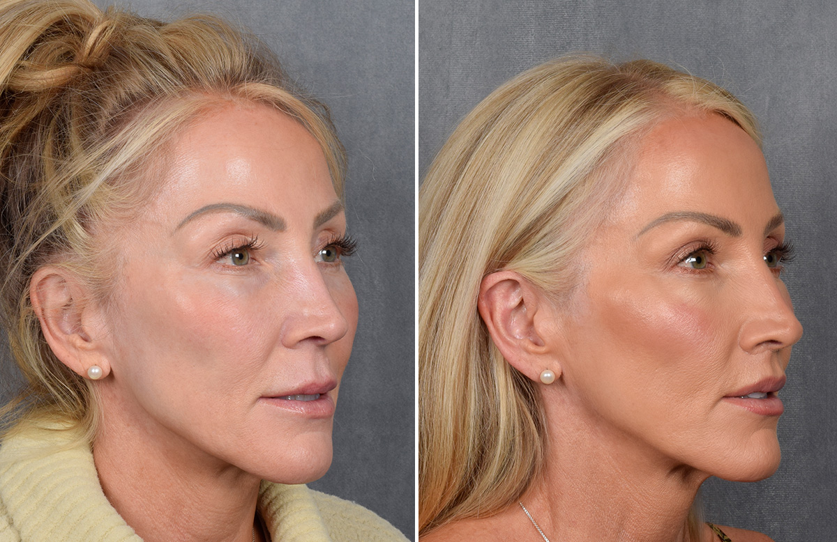 Lip Lift Before & After Gallery - Patient 242147 - Image 9