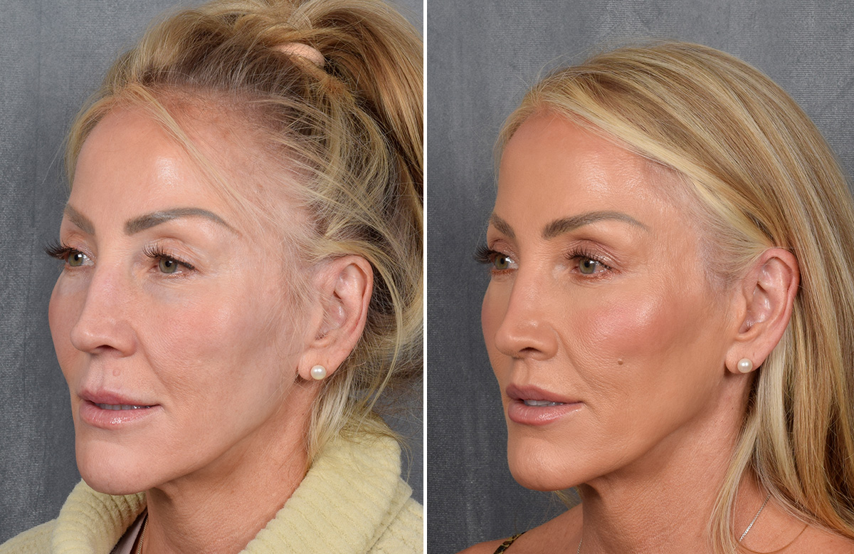 Lip Lift Before & After Gallery - Patient 242147 - Image 11