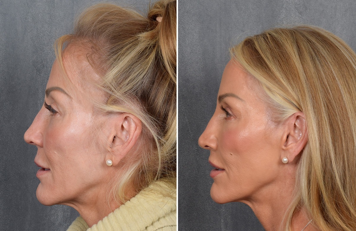 Lip Lift Before & After Gallery - Patient 242147 - Image 12