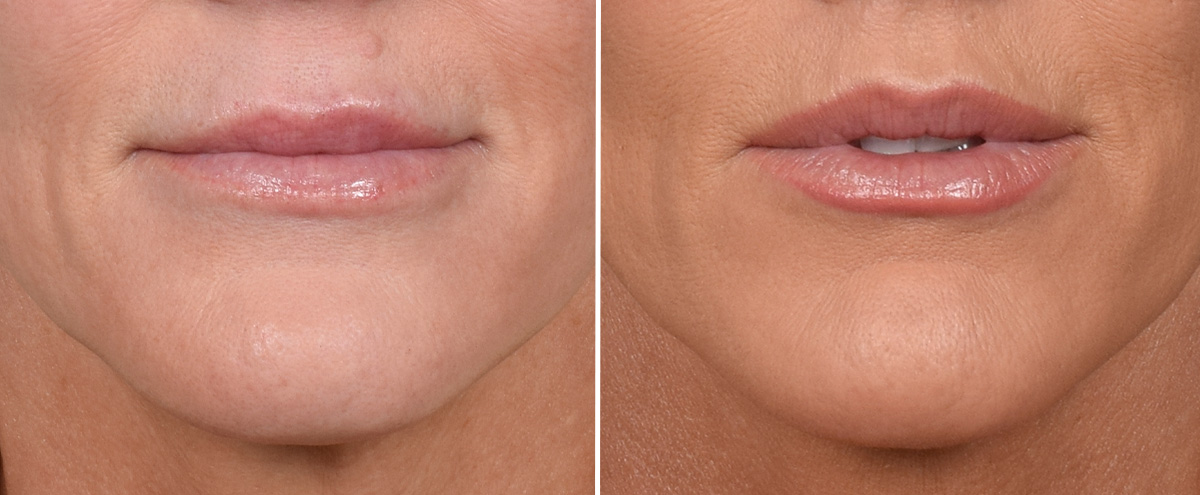 Lip Lift Before & After Gallery - Patient 242147 - Image 1