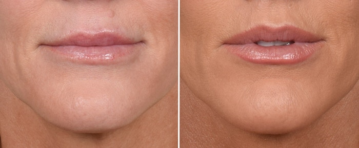 Lip Lift Before & After Gallery - Patient 242147 - Image 1
