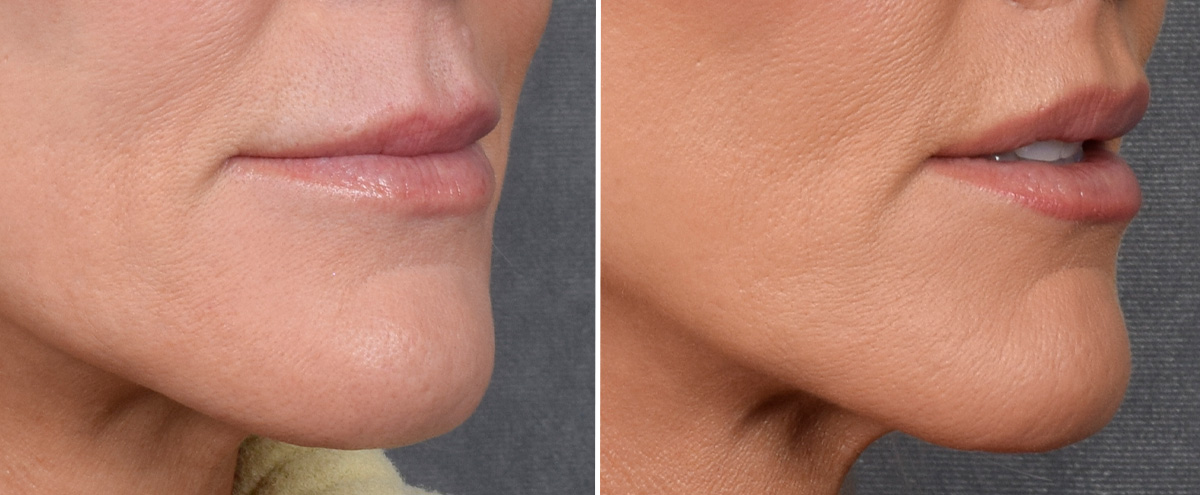 Lip Lift Before & After Gallery - Patient 242147 - Image 3