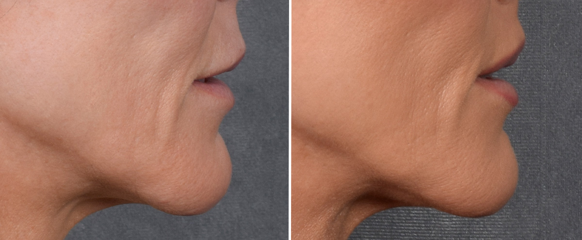 Lip Lift Before & After Gallery - Patient 242147 - Image 4