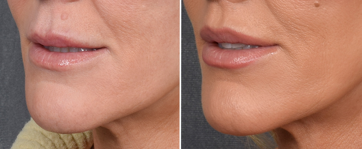 Lip Lift Before & After Gallery - Patient 242147 - Image 5