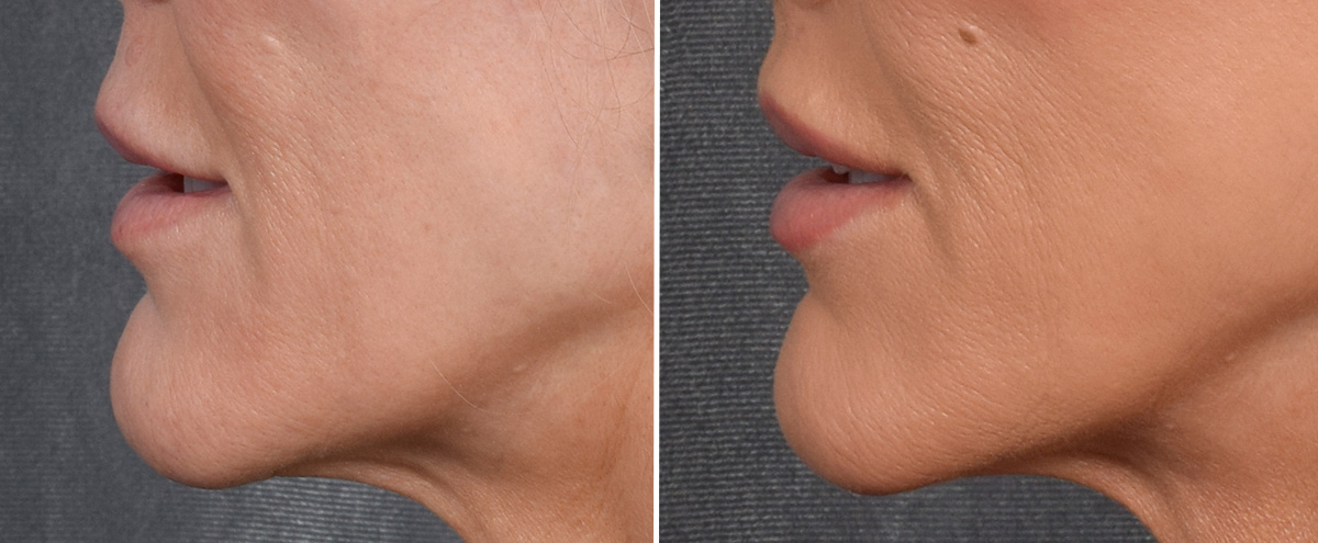 Lip Lift Before & After Gallery - Patient 242147 - Image 6