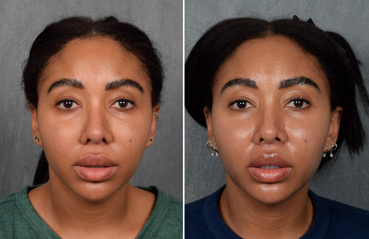 Lip Lift Before & After Gallery - Patient 592360 - Image 7