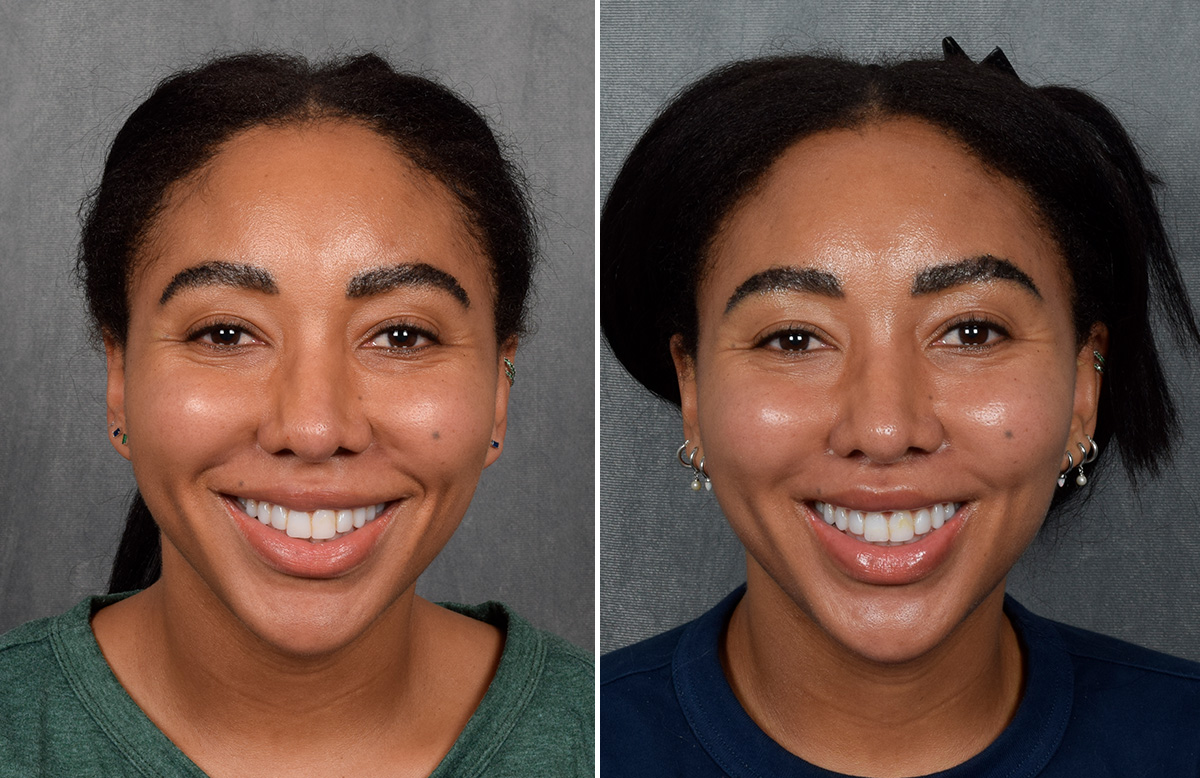 Lip Lift Before & After Gallery - Patient 592360 - Image 8