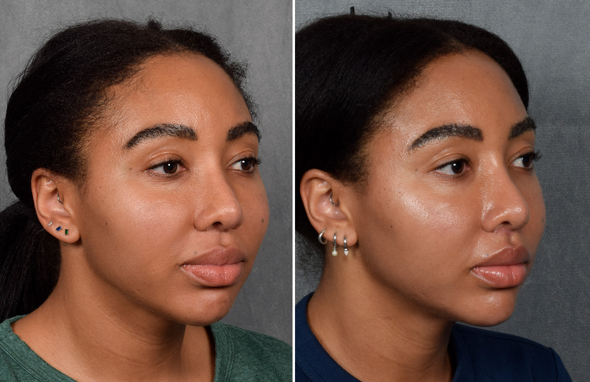 Lip Lift Before & After Gallery - Patient 592360 - Image 9