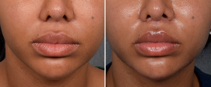 Lip Lift Before & After Gallery - Patient 592360 - Image 1