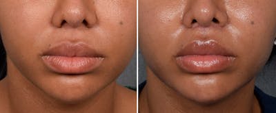 Lip Lift Before & After Gallery - Patient 592360 - Image 1