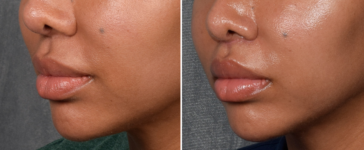 Lip Lift Before & After Gallery - Patient 592360 - Image 5