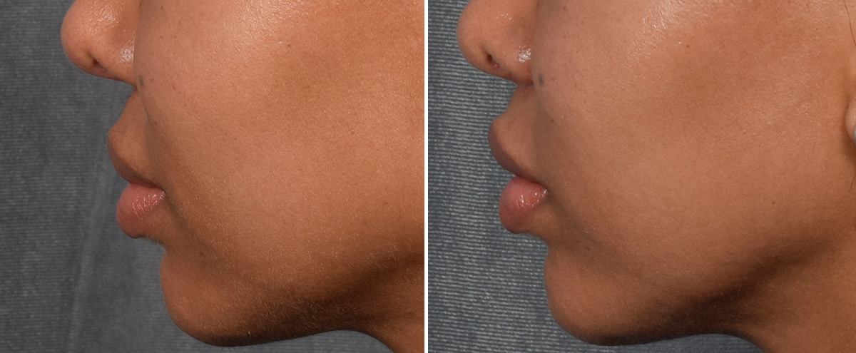 Lip Lift Before & After Gallery - Patient 592360 - Image 6