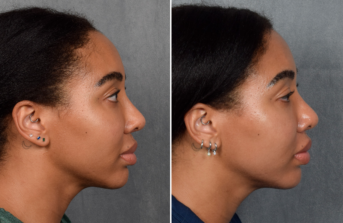 Lip Lift Before & After Gallery - Patient 592360 - Image 10