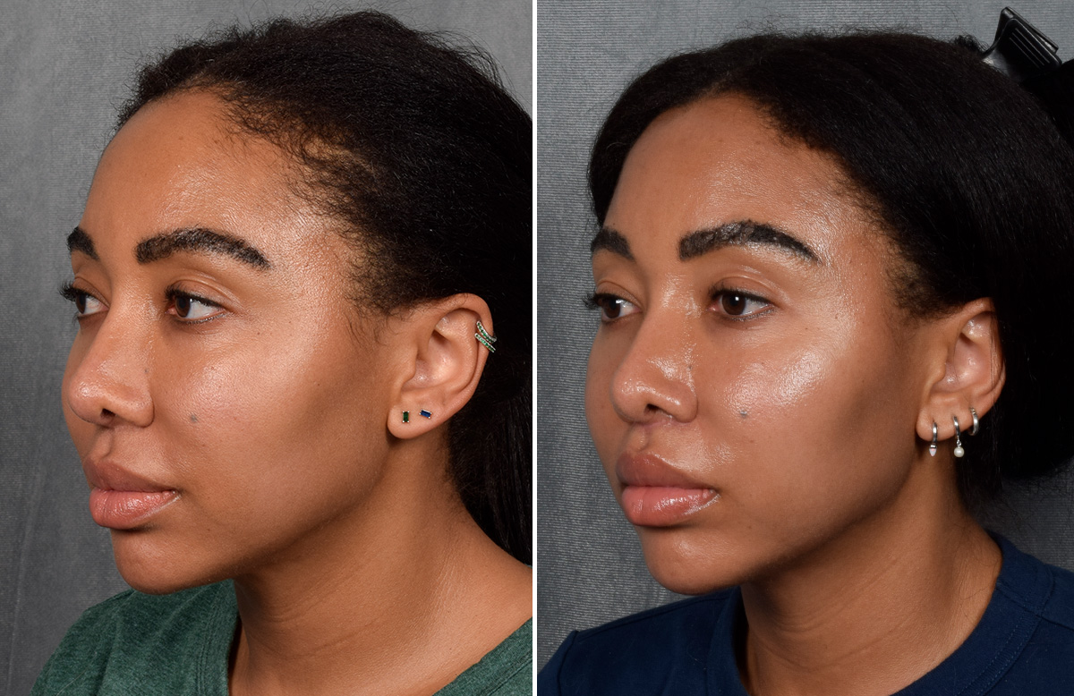 Lip Lift Before & After Gallery - Patient 592360 - Image 11