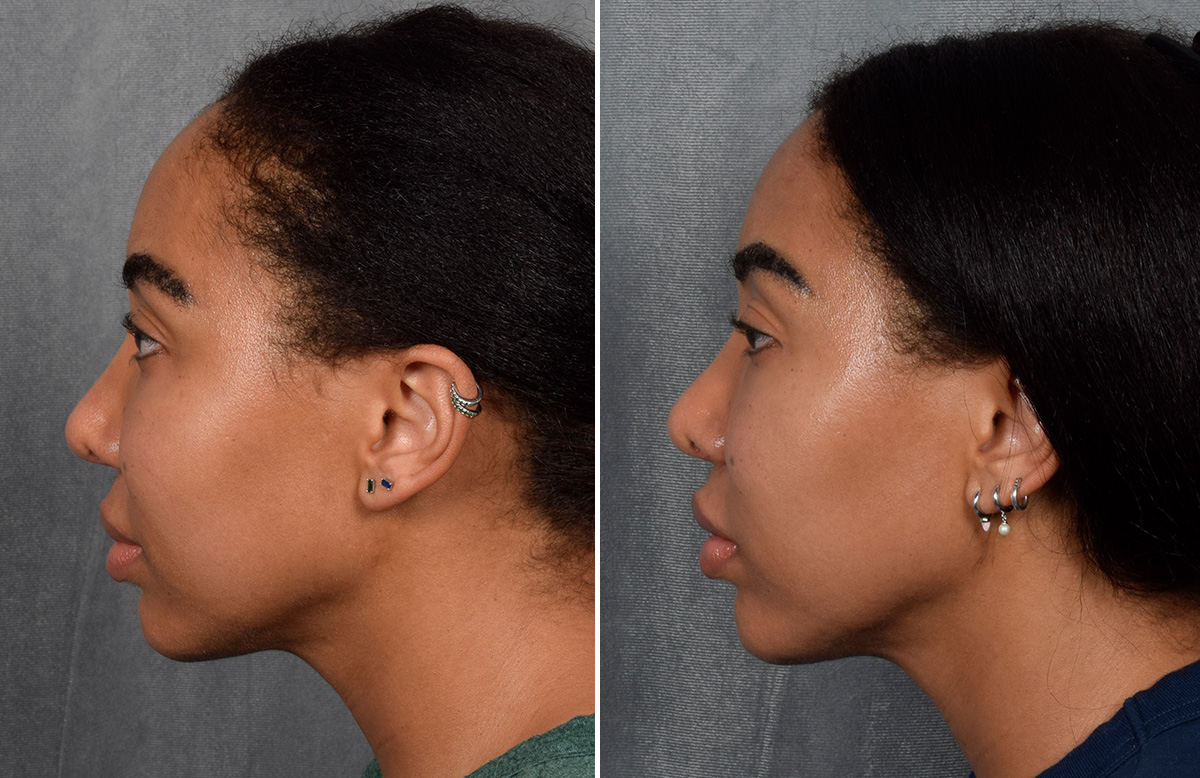Lip Lift Before & After Gallery - Patient 592360 - Image 12