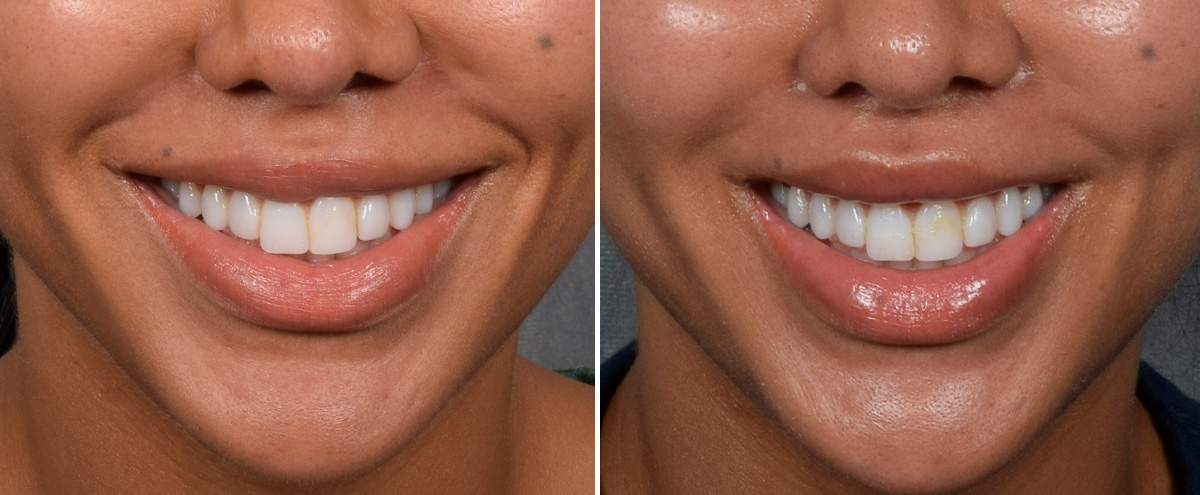 Lip Lift Before & After Gallery - Patient 592360 - Image 2