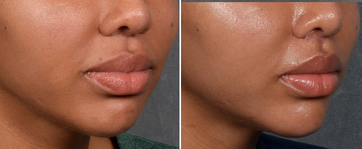 Lip Lift Before & After Gallery - Patient 592360 - Image 3