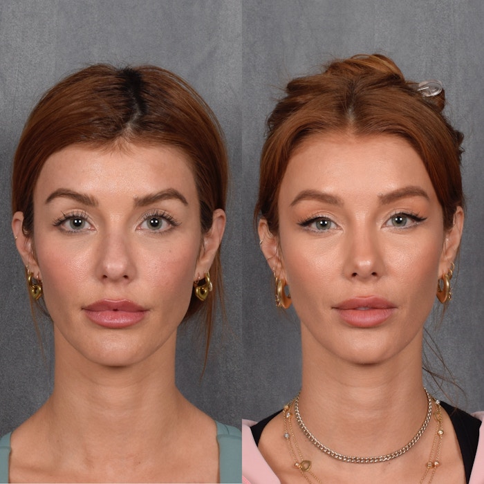 Upper Blepharoplasty Before & After Gallery - Patient 132259 - Image 1