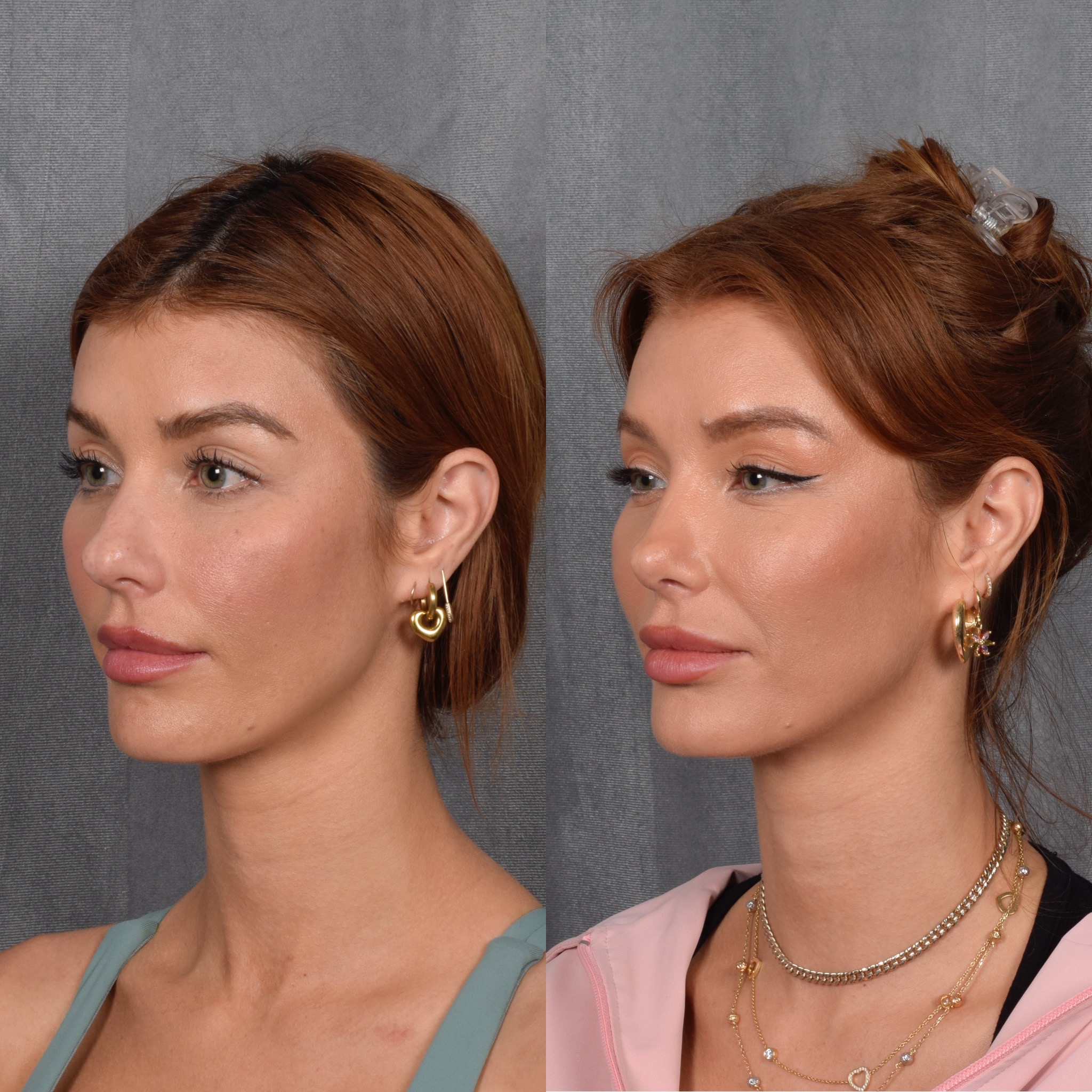 Upper Blepharoplasty Before & After Gallery - Patient 132259 - Image 5