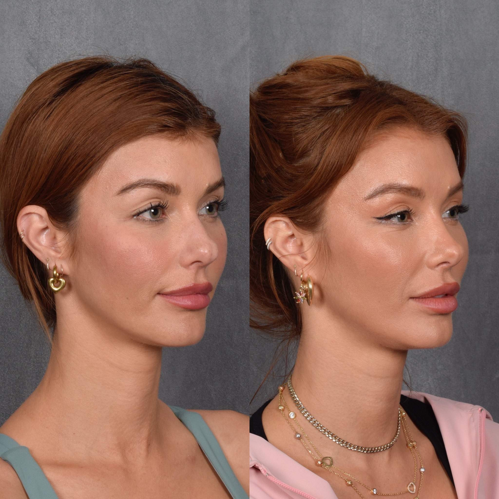 Upper Blepharoplasty Before & After Gallery - Patient 132259 - Image 2