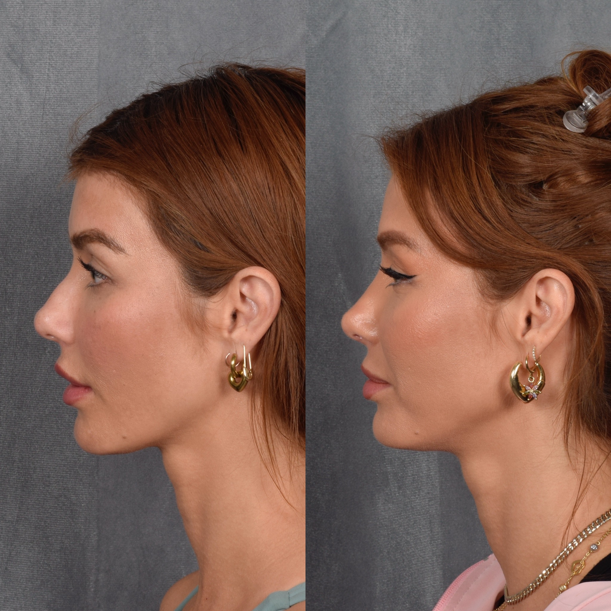 Upper Blepharoplasty Before & After Gallery - Patient 132259 - Image 6