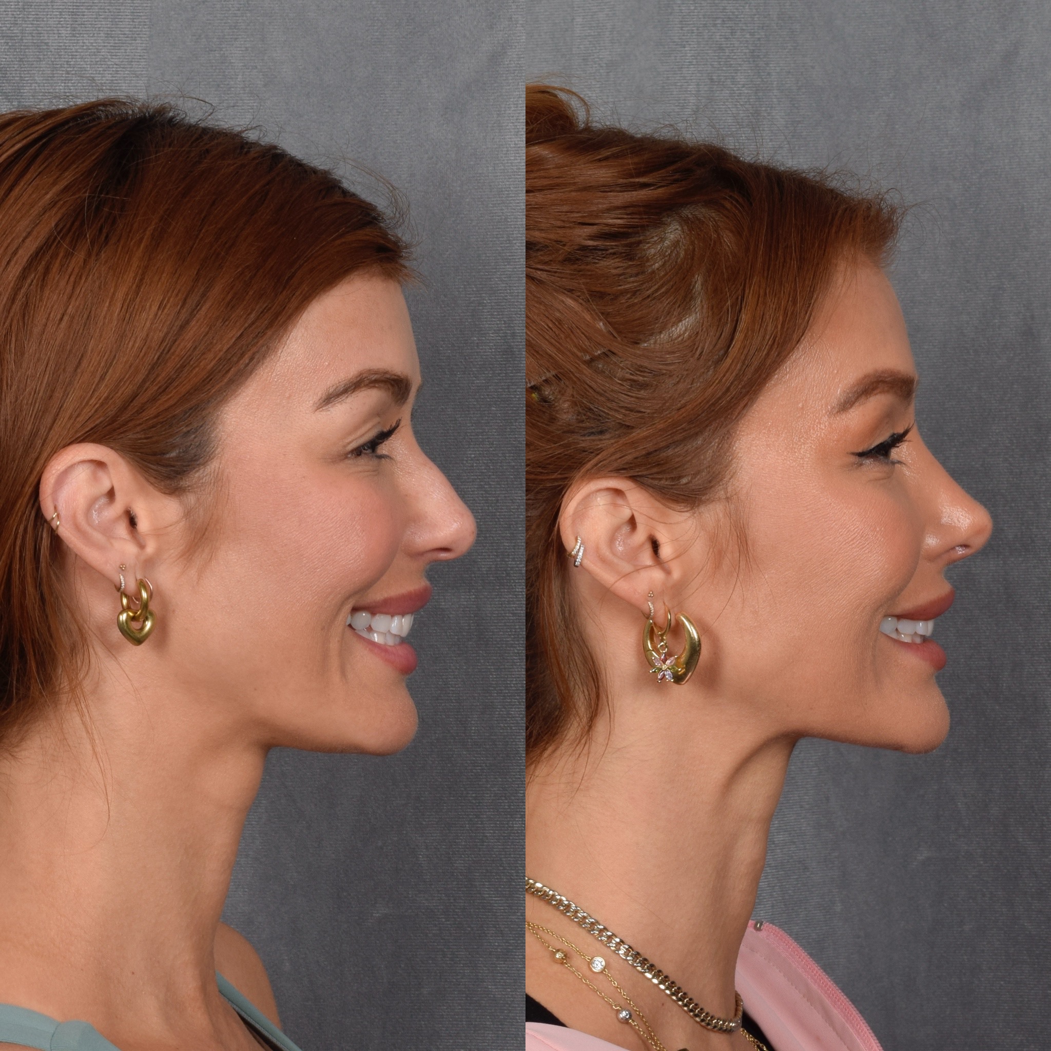 Upper Blepharoplasty Before & After Gallery - Patient 132259 - Image 4