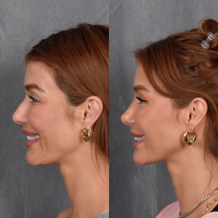 Rhinoplasty Before & After Gallery - Patient 174931 - Image 1