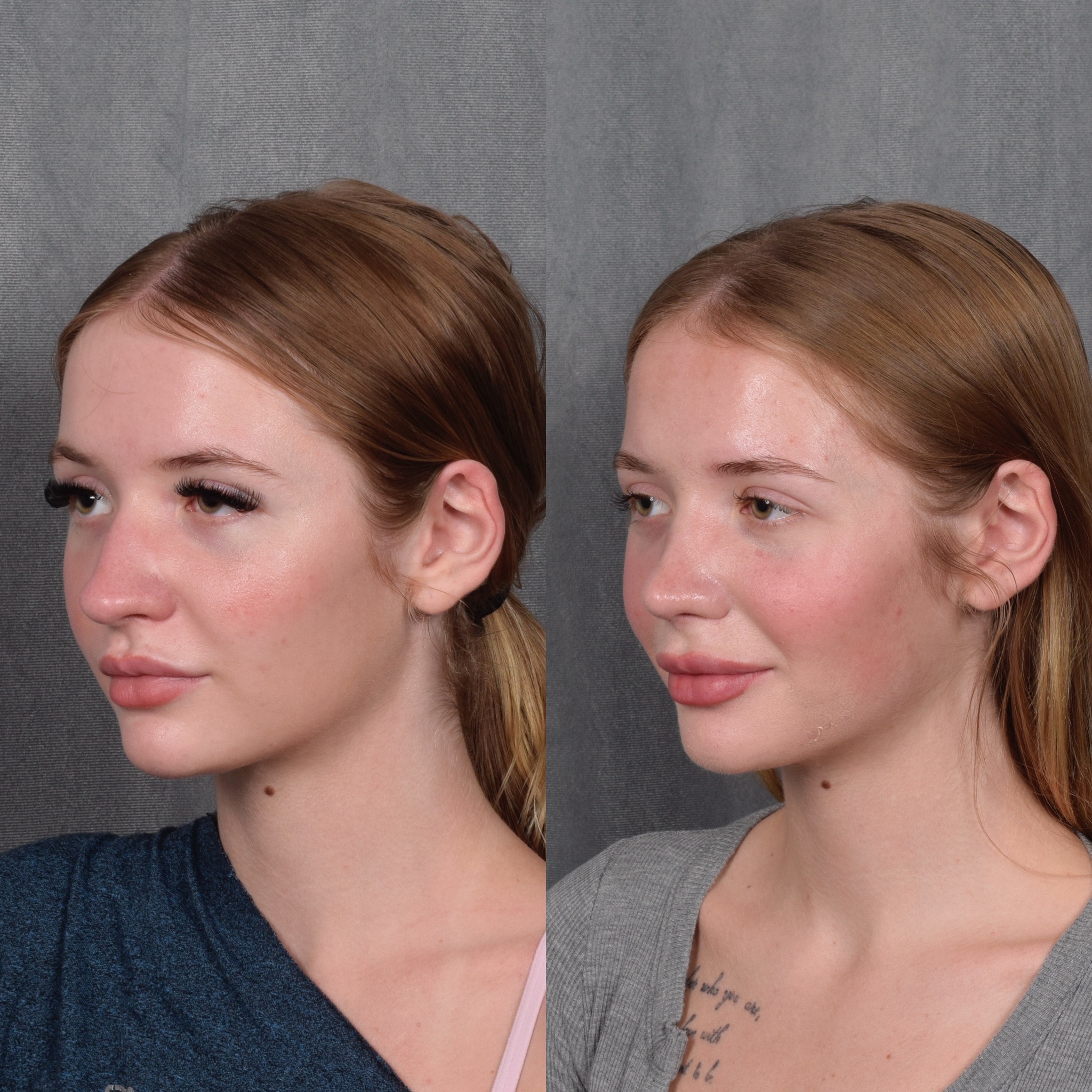 Rhinoplasty Before & After Gallery - Patient 105222 - Image 3