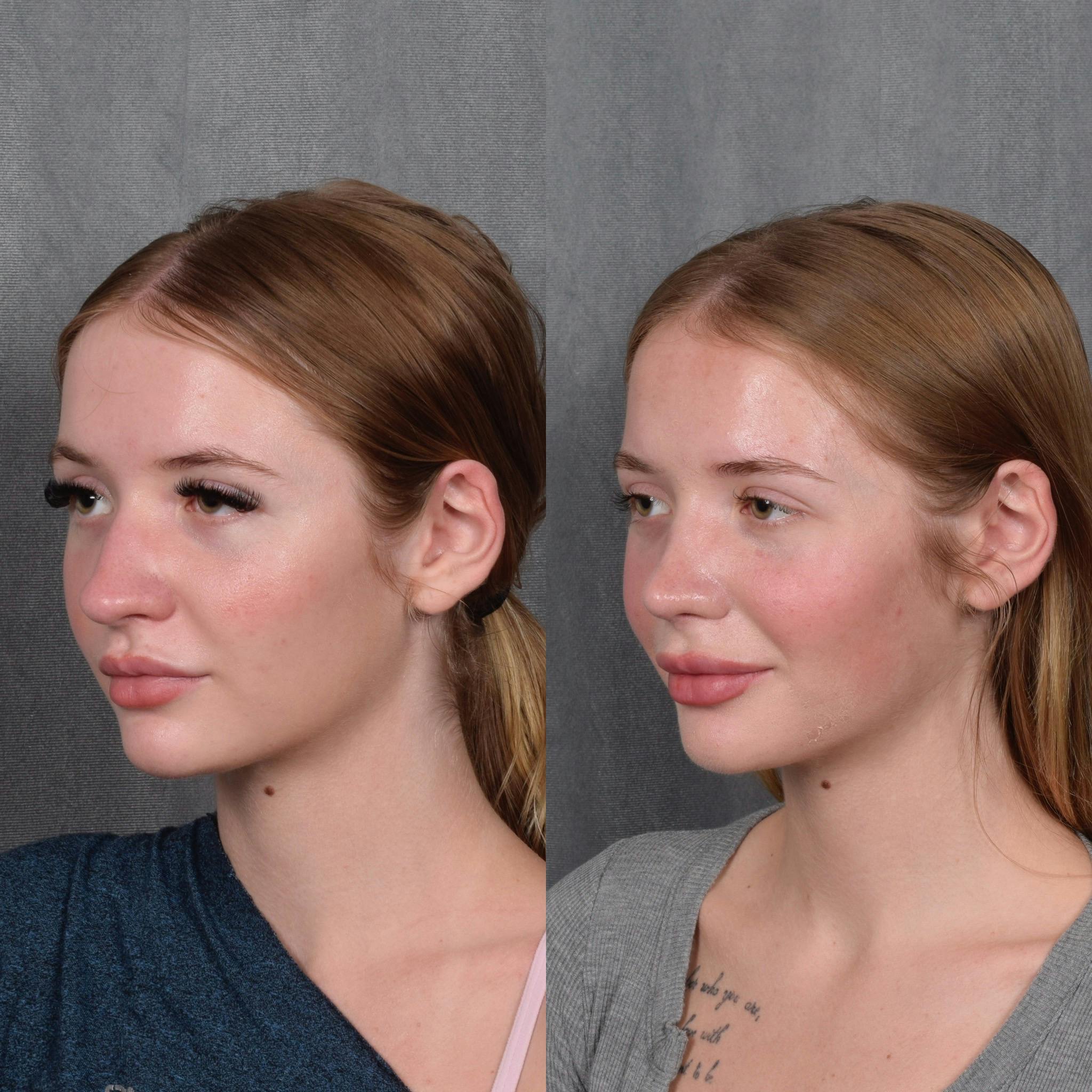 Rhinoplasty Before & After Gallery - Patient 105222 - Image 3