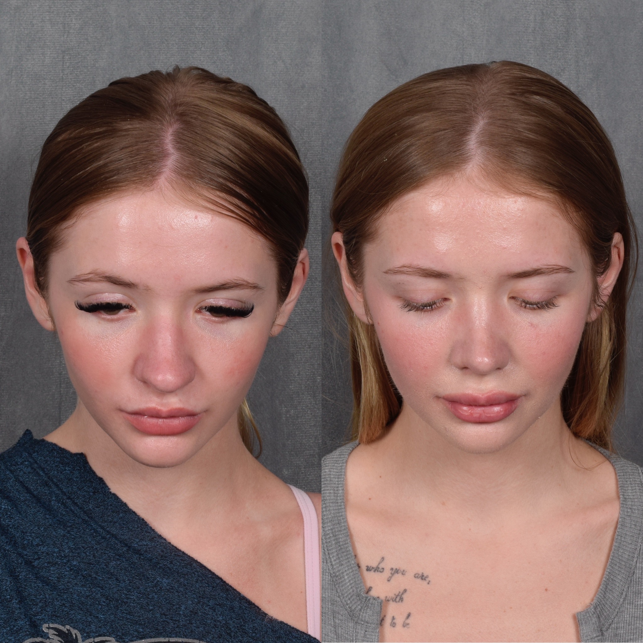 Rhinoplasty Before & After Gallery - Patient 105222 - Image 8