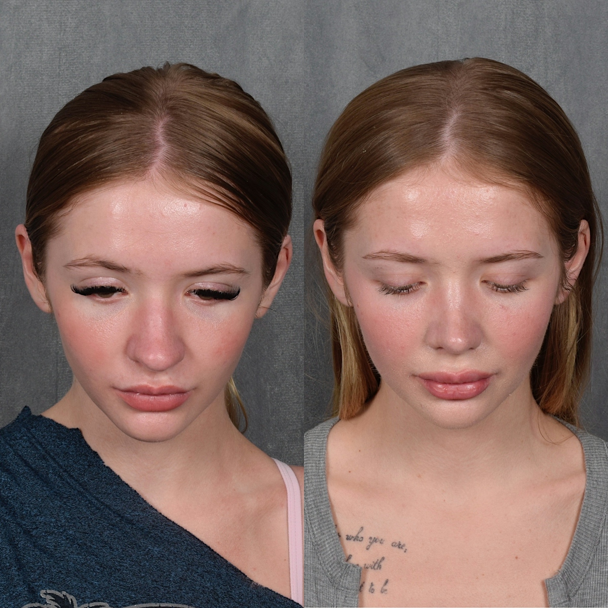 Rhinoplasty Before & After Gallery - Patient 105222 - Image 8