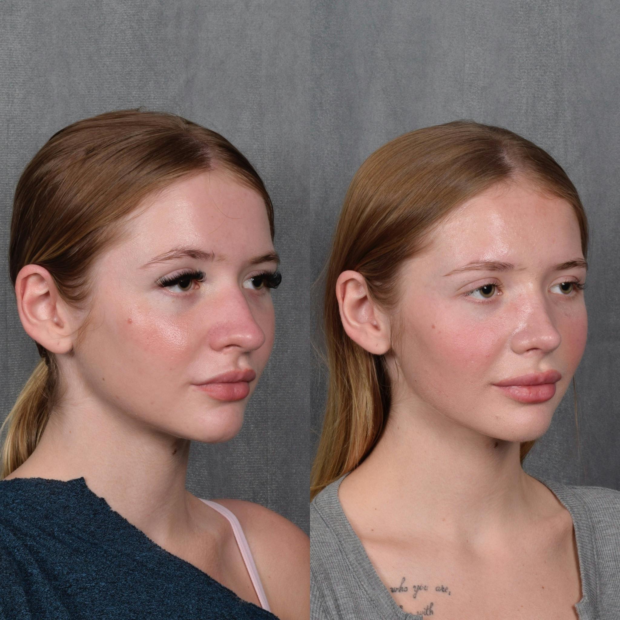 Rhinoplasty Before & After Gallery - Patient 105222 - Image 5